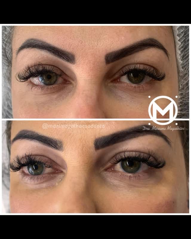 Resultado de rejuvenescimento facial realizado pela Dra. Mariana Magalhães