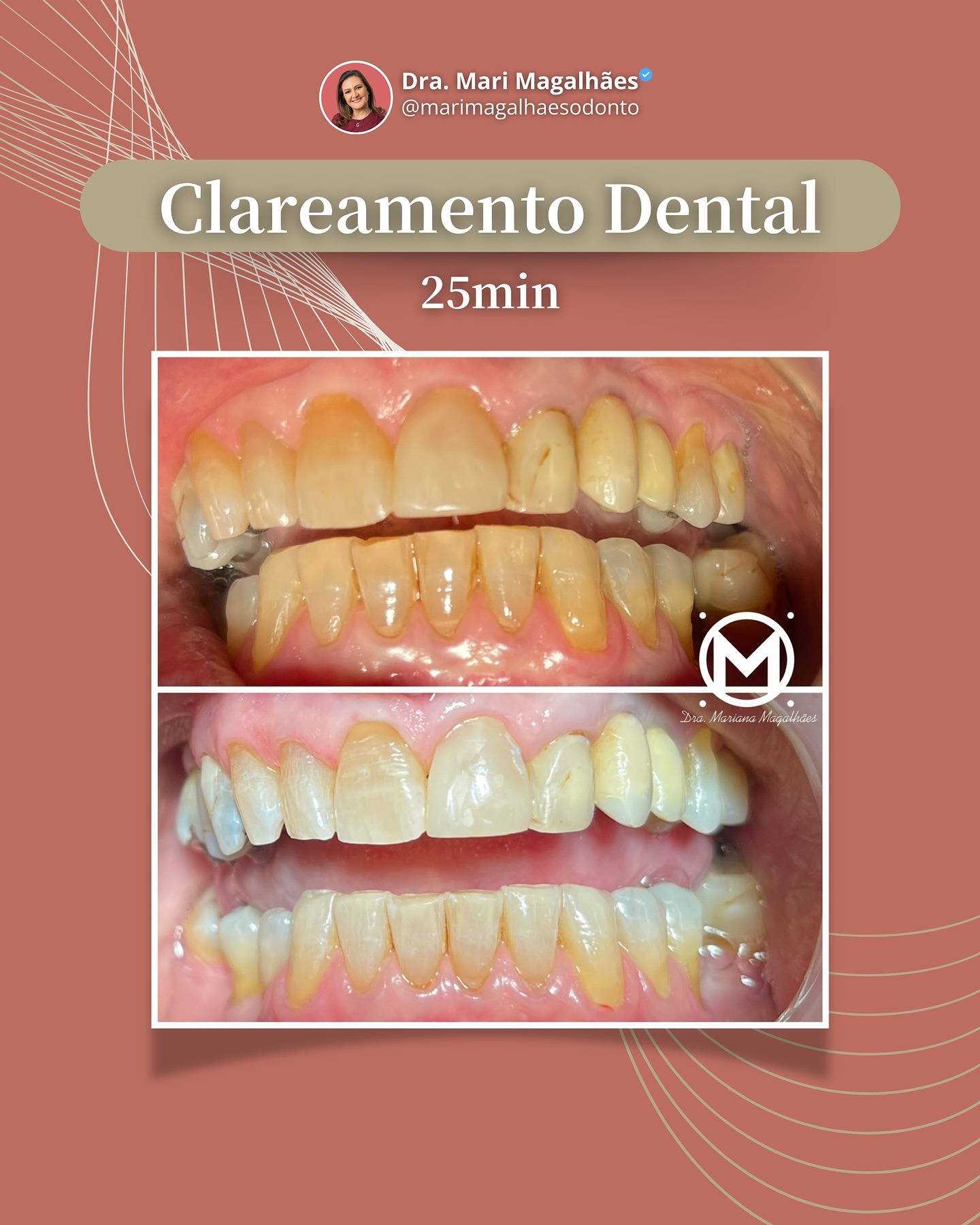Resultado de clareamento dental realizado pela Dra. Mariana Magalhães