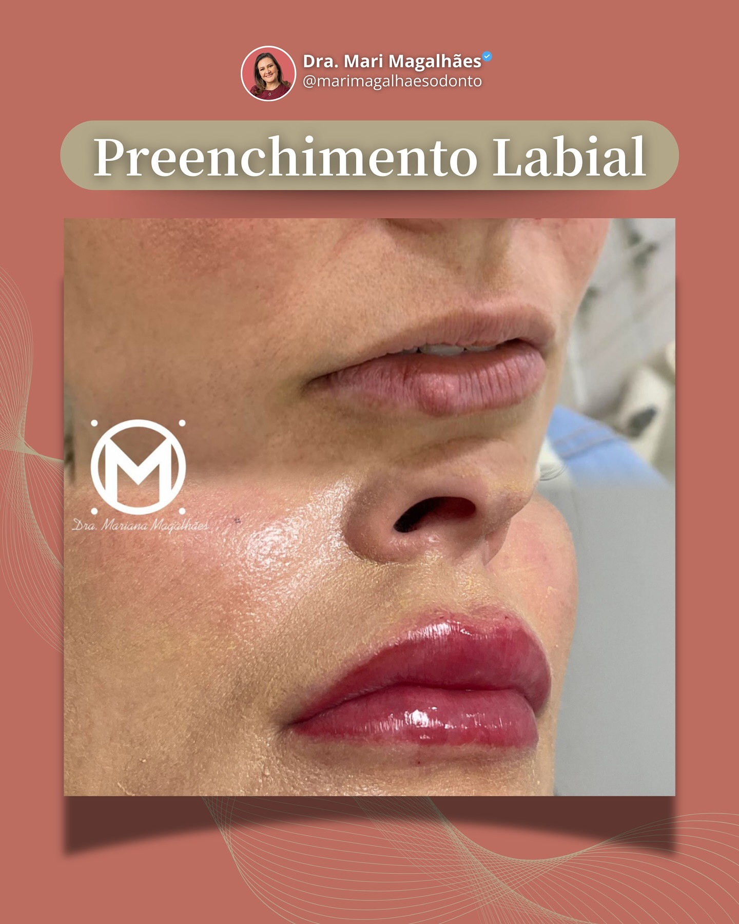 Resultado de preenchimento labial realizado pela Dra. Mariana Magalhães