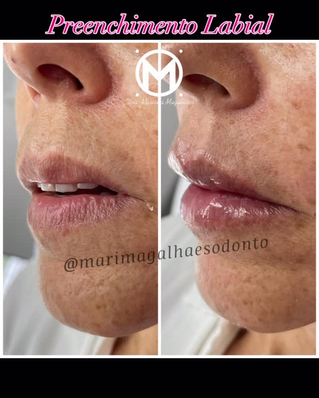 Resultado de preenchimento labial realizado pela Dra. Mariana Magalhães