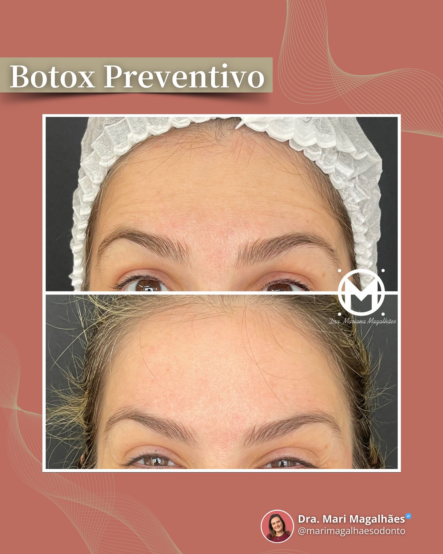 Resultado de botox preventivo realizado pela Dra. Mariana Magalhães