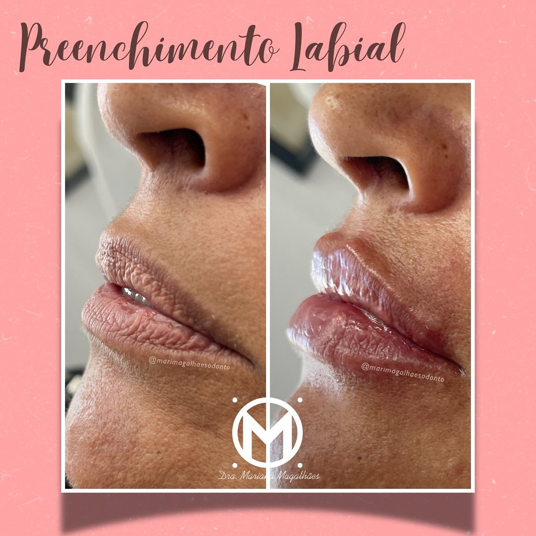 Resultado de preenchimento labial realizado pela Dra. Mariana Magalhães